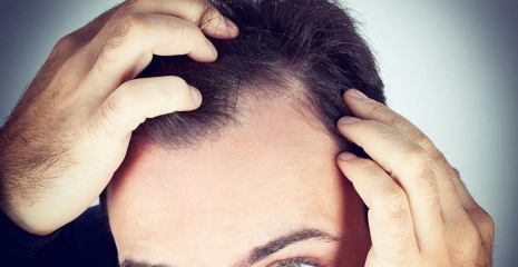 stress-hair-loss