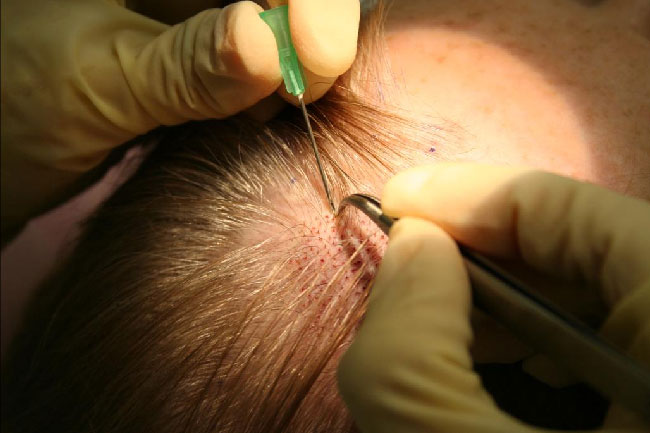hair-transplant-surgery-risks
