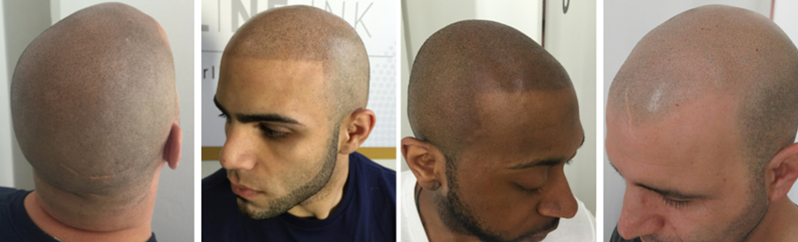 scalp-micropigmentation-customers